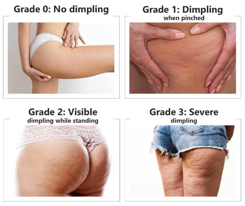 Representation of the stages of cellulite development Camberley