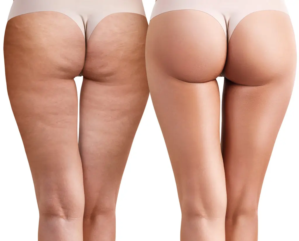 Read about cellulite Camberley: causes, treatments, and debunked myths